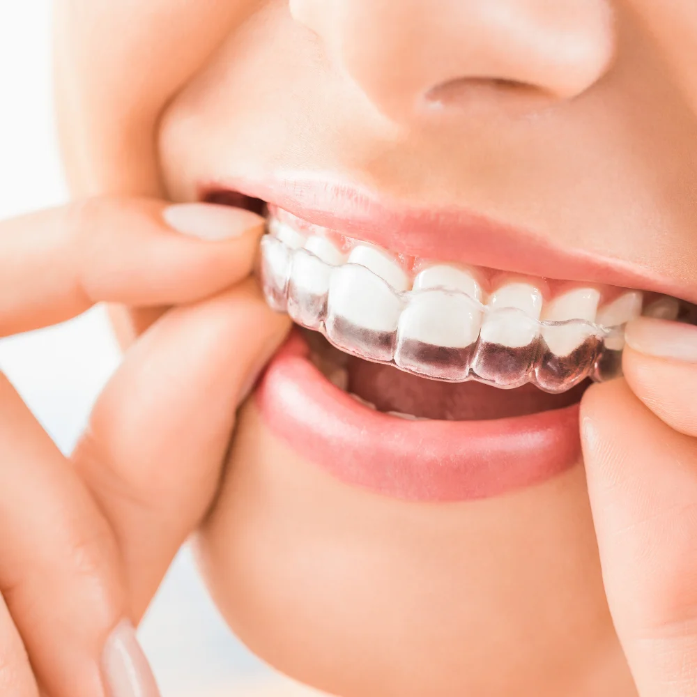 Braces and Clear Aligners