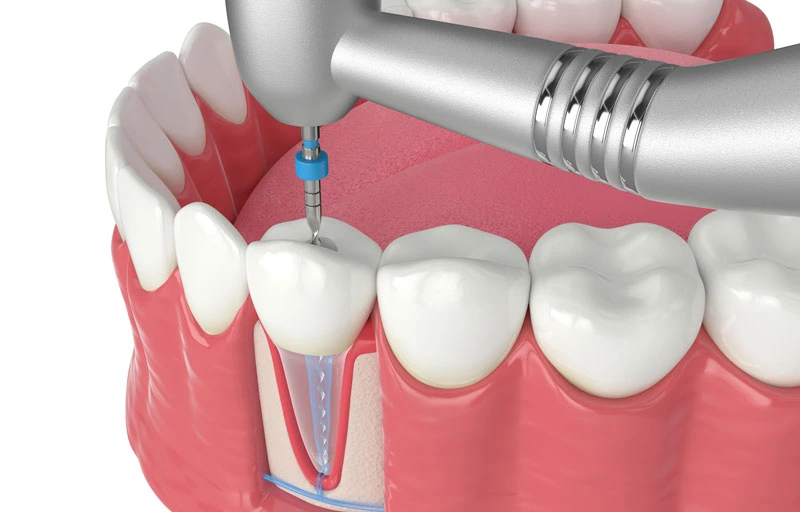 Root Canal Treatment