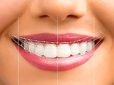 Smile Design
